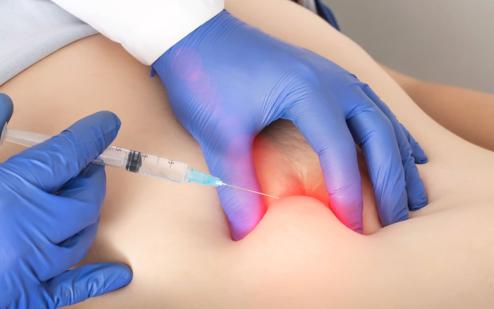 Epidural Steroid Injections in Lower Back